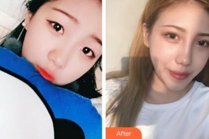 武警云南省邊防總隊(duì)醫(yī)院整形美容中心楊俊濤整形價(jià)格表附眼部綜合案例展示