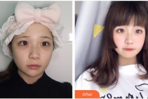 武警云南省邊防總隊(duì)醫(yī)院整形美容中心陶長(zhǎng)偉整形價(jià)格表附外切祛眼袋案例展示