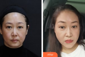 海南夢(mèng)妮幻整形?？崎T診部何濤整形價(jià)格表附皮膚美容案例展示