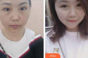 云南華美美萊美容醫(yī)院路秀波整形價(jià)格表附激光祛斑案例展示