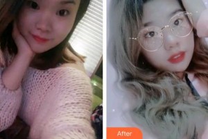 云南華美美萊美容醫(yī)院劉乙辰整形價(jià)格表附牙齒隱形矯正案例展示