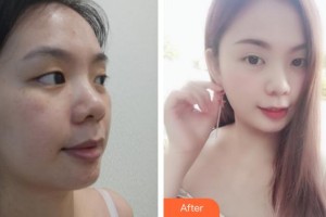 云南中醫(yī)學(xué)院附設(shè)中醫(yī)醫(yī)院整形美容中心李麗潔整形價(jià)格表附無(wú)針?biāo)獍咐故?>
</a>
<h3 class=