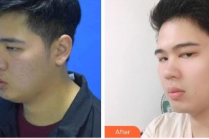 云南銅雀臺(tái)整形美容醫(yī)院李信奎院長(zhǎng)整形價(jià)格表附減脂案例展示