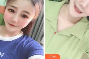 武警云南省邊防總隊(duì)醫(yī)院整形美容中心舒勇整形價(jià)格表附清潔祛痘案例展示