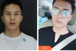 云南妤繡醫(yī)療美容診所吳建華整形價(jià)格表附光子嫩膚案例展示