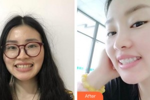 海南愛牙口腔醫(yī)院陽喚整形價格表附牙齒矯正案例展示