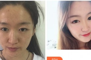 云南省第一人民醫(yī)院眼科梅妍整形價(jià)格表附激光去眼袋案例展示