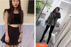 云南銅雀臺(tái)整形美容醫(yī)院鄧皓仁院長(zhǎng)整形價(jià)格表附激光祛疤案例展示