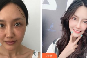 云南妤繡醫(yī)療美容診所王鳳整形價(jià)格表附彩光嫩膚案例展示