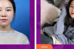 昆明夢想醫(yī)療美容醫(yī)院胡凱整形價格表附耳軟骨復(fù)合隆鼻案例展示