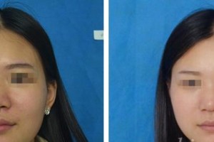 昆明醫(yī)學院整形美容中心焦圓華整形價格表附激光祛斑案例展示