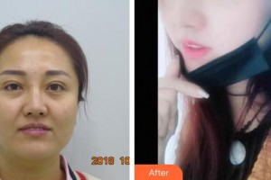 整形醫(yī)院劉小星整形價格表附鼻部綜合案例展示