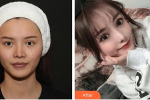 昆明都市儷人美容醫(yī)院楊麗璇整形價格表附鼻修復(fù)案例展示