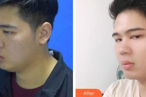 昆明醫(yī)學(xué)院第二附屬醫(yī)院燒傷整形科付晉鳳整形價格表附減脂案例展示