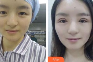 昆明超然醫(yī)學(xué)整形美容外科醫(yī)院李晉豫整形價格表附切開雙眼皮案例展示