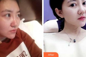 昆明吳氏嘉美美容醫(yī)院吳承道整形價(jià)格表附鼻部綜合案例展示