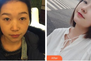 昆明同仁醫(yī)院醫(yī)療美容科楊恰佳整形價(jià)格表附假體隆鼻案例展示