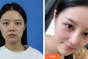 昆明麗都醫(yī)療美容醫(yī)院魯開化整形價(jià)格表附肋軟骨隆鼻案例展示