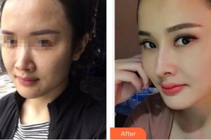 昆明維多利亞醫(yī)療美容醫(yī)院徐根艷整形價(jià)格表附去痘印痘坑案例展示