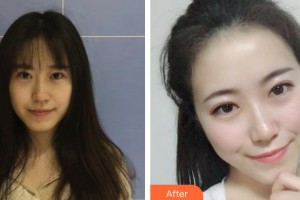 昆明都市儷人美容醫(yī)院李韻整形價(jià)格表附去痘印痘坑案例展示