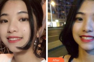 昆明前衛(wèi)美眼整形專科診所劉流整形價(jià)格表附牙齒隱形矯正案例展示