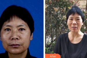 昆明市延安醫(yī)院杰西艾美容醫(yī)院謝國(guó)華整形價(jià)格表附微針美膚案例展示