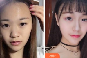 整形醫(yī)院陳茂年整形價格表附耳軟骨復(fù)合隆鼻案例展示