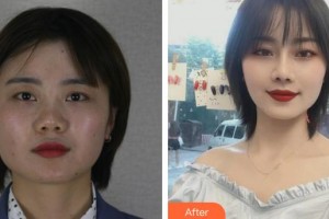 昆明同仁醫(yī)院醫(yī)療美容科劉波整形價格表附耳軟骨復(fù)合隆鼻案例展示