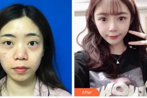 昆明維多利亞醫(yī)療美容醫(yī)院成昌燮整形價(jià)格表附鼻部綜合案例展示