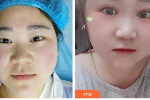 昆明赫柏醫(yī)療美容門診部金東杰整形價格表附開內(nèi)眼角案例展示