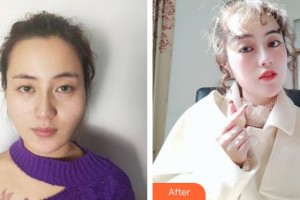 昆明美立方（原大華）醫(yī)療美容醫(yī)院段瑞平整形價(jià)格表附顴骨顴弓整形術(shù)案例展示