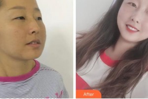 整形醫(yī)院董慧整形價格表附面部吸脂案例展示