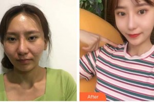 昆明愛萊美醫(yī)療美容醫(yī)院徐和林整形價(jià)格表附顴骨顴弓整形術(shù)案例展示