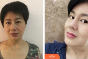 昆明美吉星醫(yī)療美容門診部陸磊整形價(jià)格表附膨體隆鼻案例展示