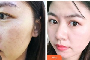 昆明韓辰整形醫(yī)院李杰整形價(jià)格表附微針美膚案例展示