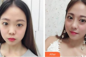 昆明同仁醫(yī)院醫(yī)療美容科鐘青杰整形價(jià)格表附鼻部綜合案例展示