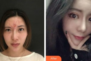 昆明都市儷人美容醫(yī)院李關(guān)文整形價格表附隆鼻案例展示