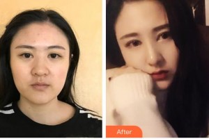 昆明夢想醫(yī)療美容醫(yī)院李華整形價格表附耳軟骨復(fù)合隆鼻案例展示