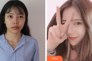 昆明美立方（原大華）醫(yī)療美容醫(yī)院李勁良整形價格表附鼻部綜合案例展示