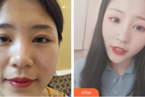 昆明赫柏醫(yī)療美容門診部楊軍叢整形價格表附鼻部綜合案例展示