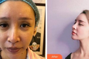 昆明美立方（原大華）醫(yī)療美容醫(yī)院高丹整形價格表附鼻修復(fù)案例展示