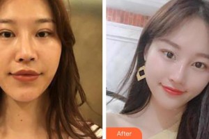 昆明夢想醫(yī)療美容醫(yī)院祝勇整形價格表附激光祛斑案例展示