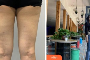 昆明愛萊美醫(yī)療美容醫(yī)院曾垂紳整形價格表附吸脂案例展示