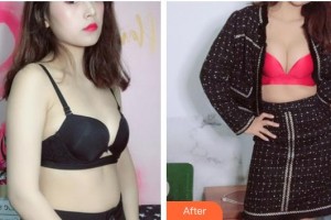 昆明薇莎整形美容醫(yī)院李銀石整形價格表附自體脂肪隆胸案例展示