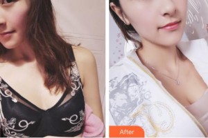 昆明麗都醫(yī)療美容醫(yī)院董玉潔整形價格表附自體脂肪隆胸案例展示