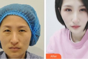 昆明美伊萊醫(yī)療美容門診部陳玉瓊整形價格表附眼部修復例展示