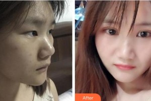 昆明達美醫(yī)療美容診所游桂萍整形價格表附埋線雙眼皮案例展示