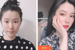 昆明達美醫(yī)療美容診所楊光華整形價格表附切開雙眼皮案例展示