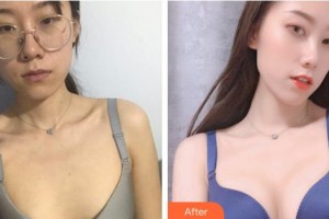 昆明夢(mèng)想醫(yī)療美容醫(yī)院童列健整形價(jià)格表附自體脂肪隆胸案例展示