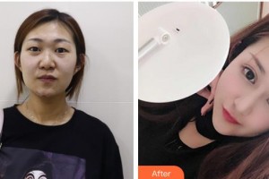 昆明夢想醫(yī)療美容醫(yī)院李成龍整形價格表附切開雙眼皮案例展示